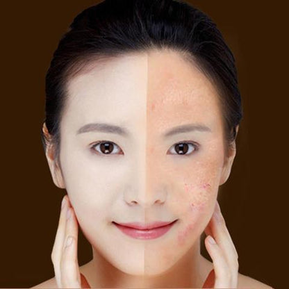 Blue Light Therapy Acne Laser Pen Soft Scar  Wrinkle Removal Treatment Device Skin Care Beauty Equipment